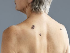 tratamento de cancer de pele sao paulo melanoma