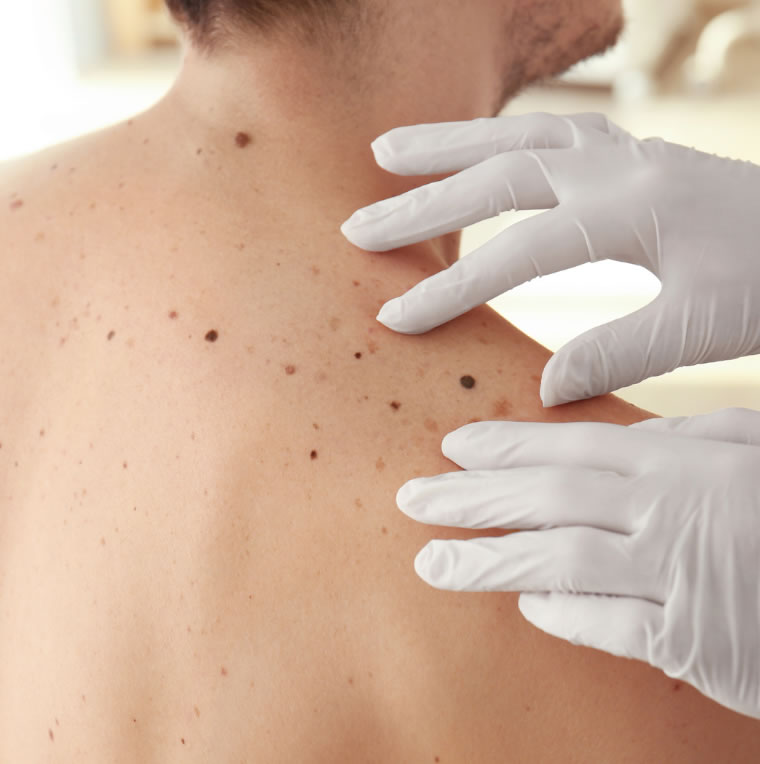 tratamento do cancer de pele em curitiba